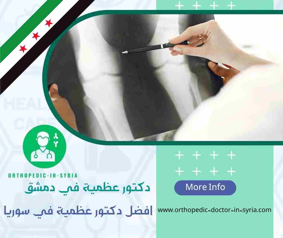 افضل دكتور عظمية في سوريا