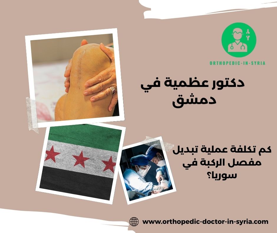 كم تكلفة عملية تبديل مفصل الركبة في سوريا؟