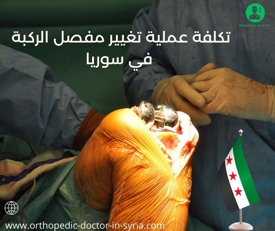 تكلفة عملية تغيير مفصل الركبة في سوريا
