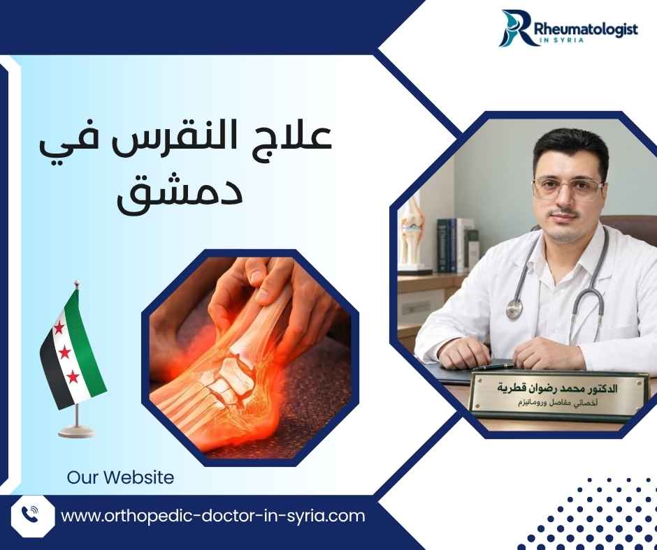 علاج النقرس في دمشق